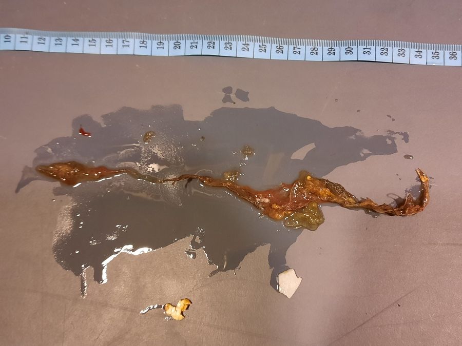 Stomach contents of the two deceased juvenile loggerhead turtles found between the plastic catch